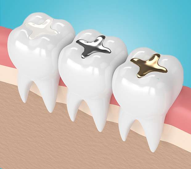Sunland Composite Fillings